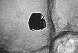 造影视频全过程,揭示血管奥秘与诊疗过程
